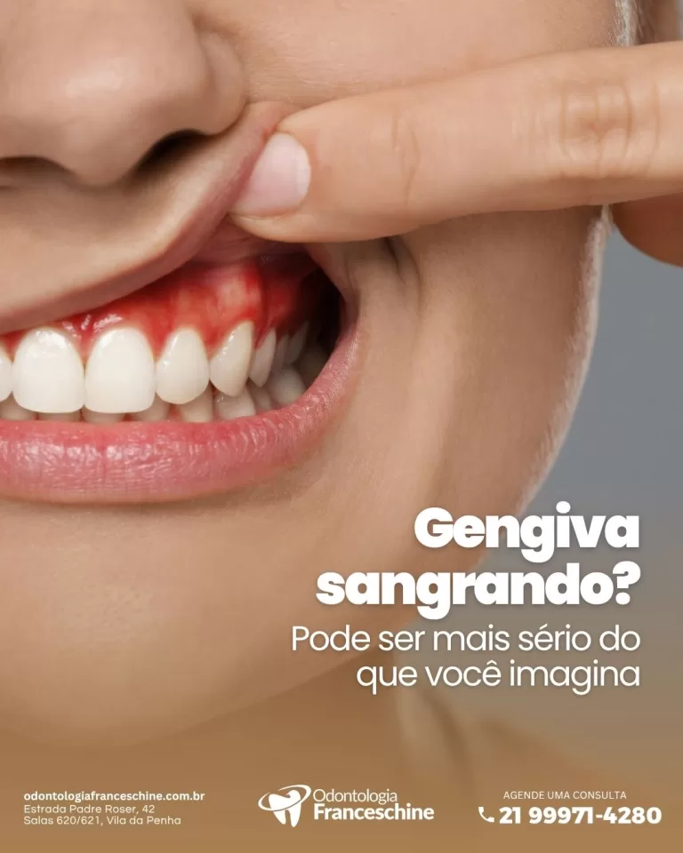 Gengiva Sangrando